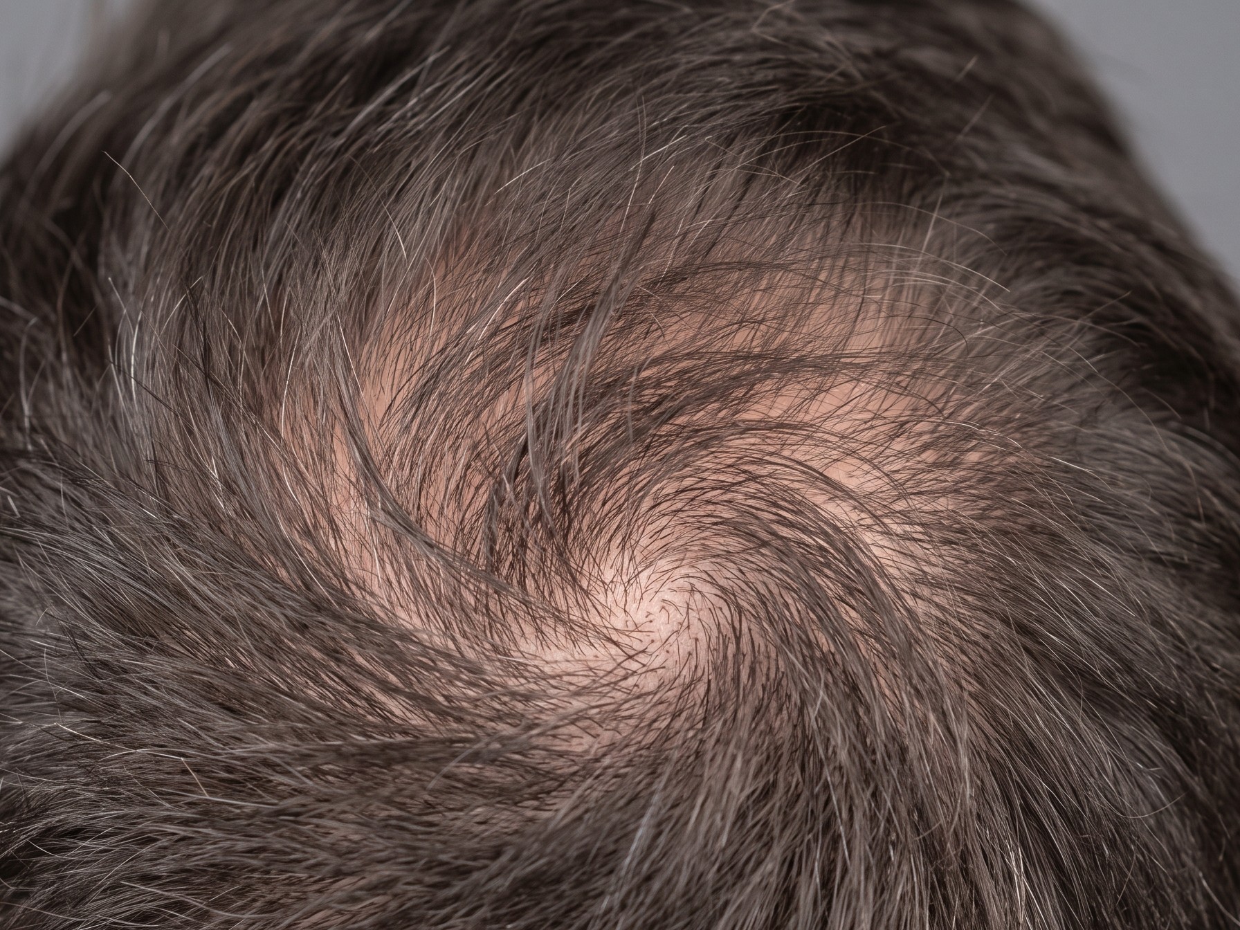 A head seen from above, showing the whole scalp and the part in the hair.