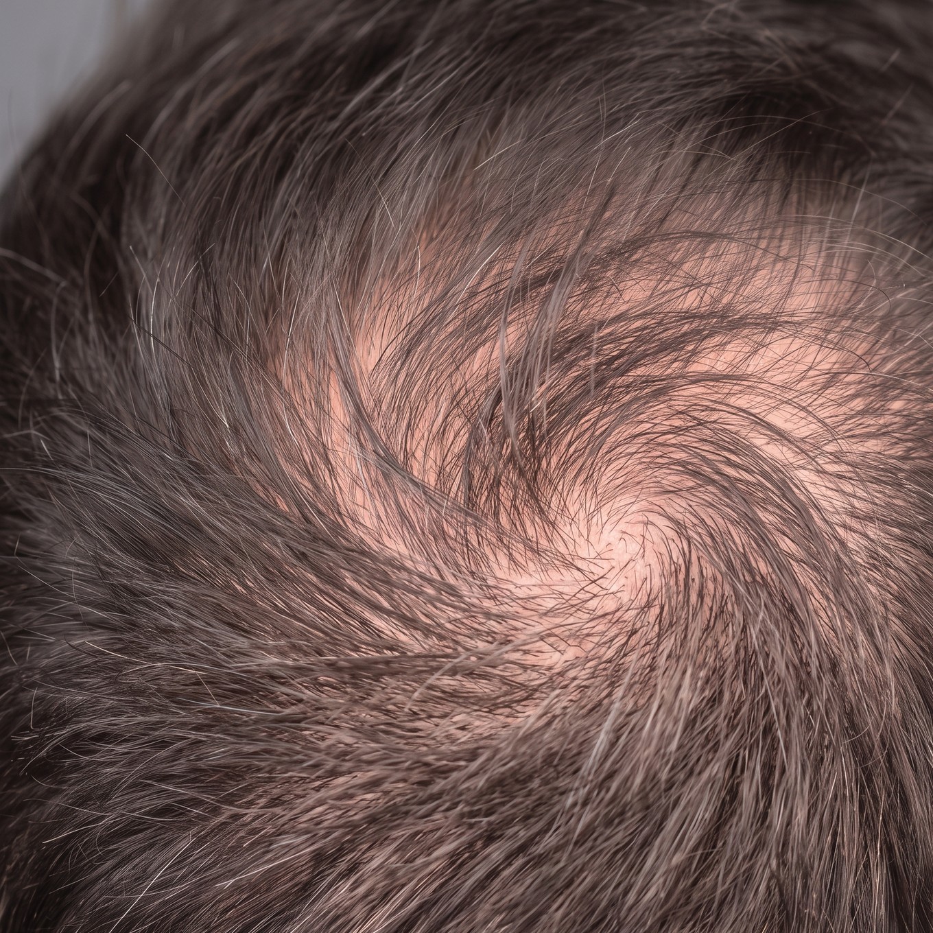 A scalp seen from above, thinning at the crown.